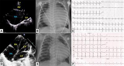 Giant right atrium in a child with dilated cardiomyopathy: A case report